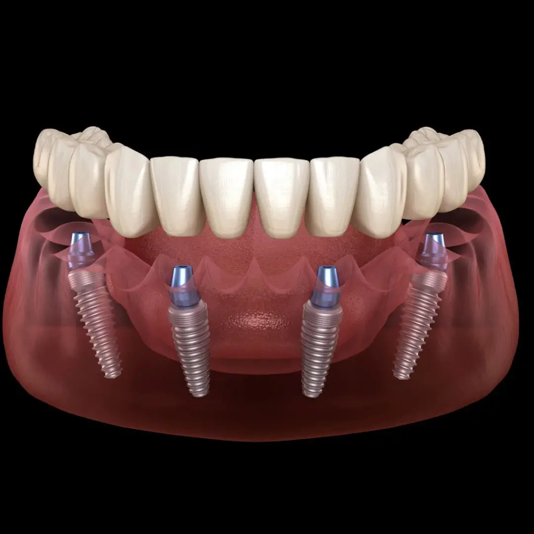 All On 4 Dental Implants in Mumbai (Mazgaon)